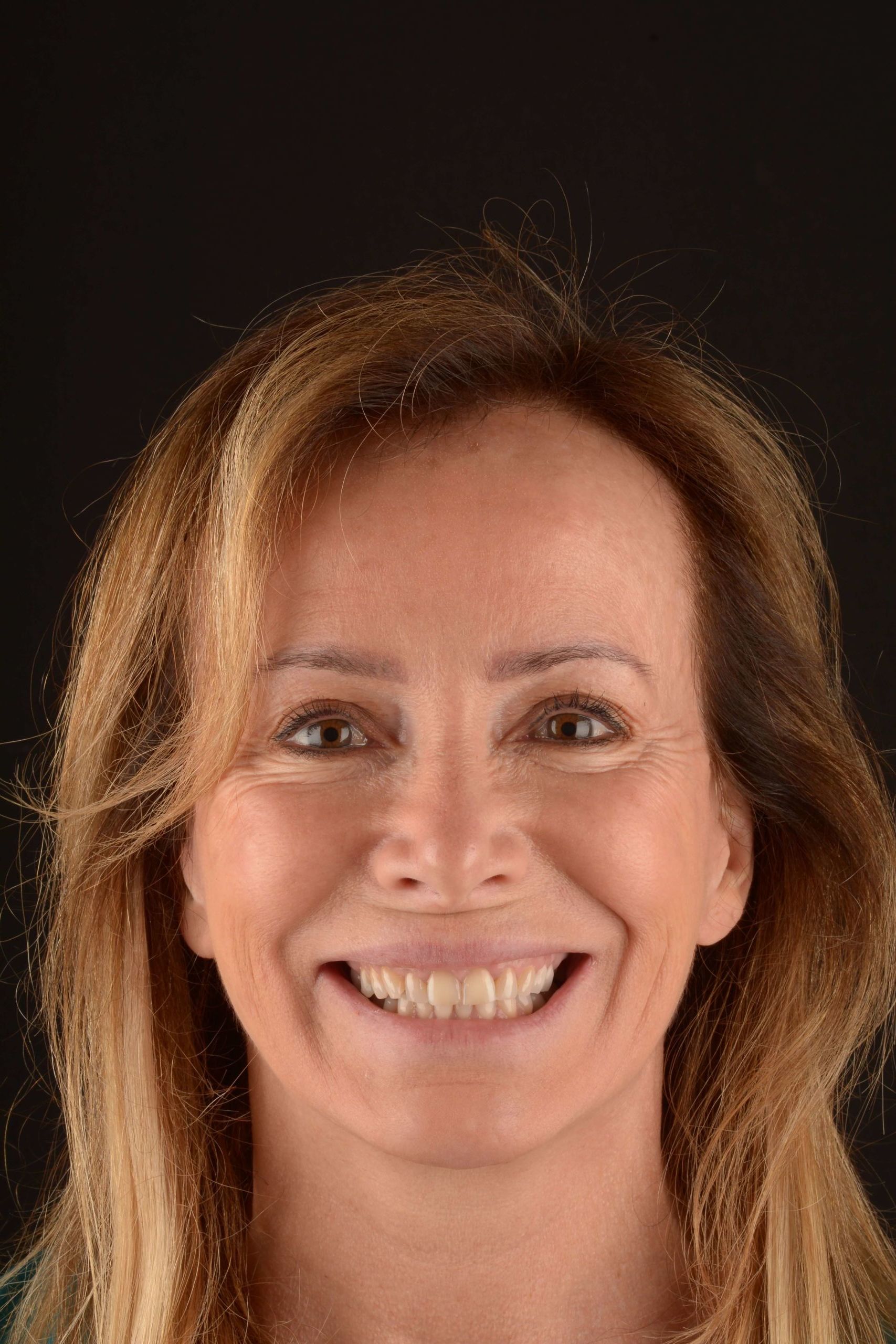 Aligneur dentaire invisible - Dr Christine Rousseau